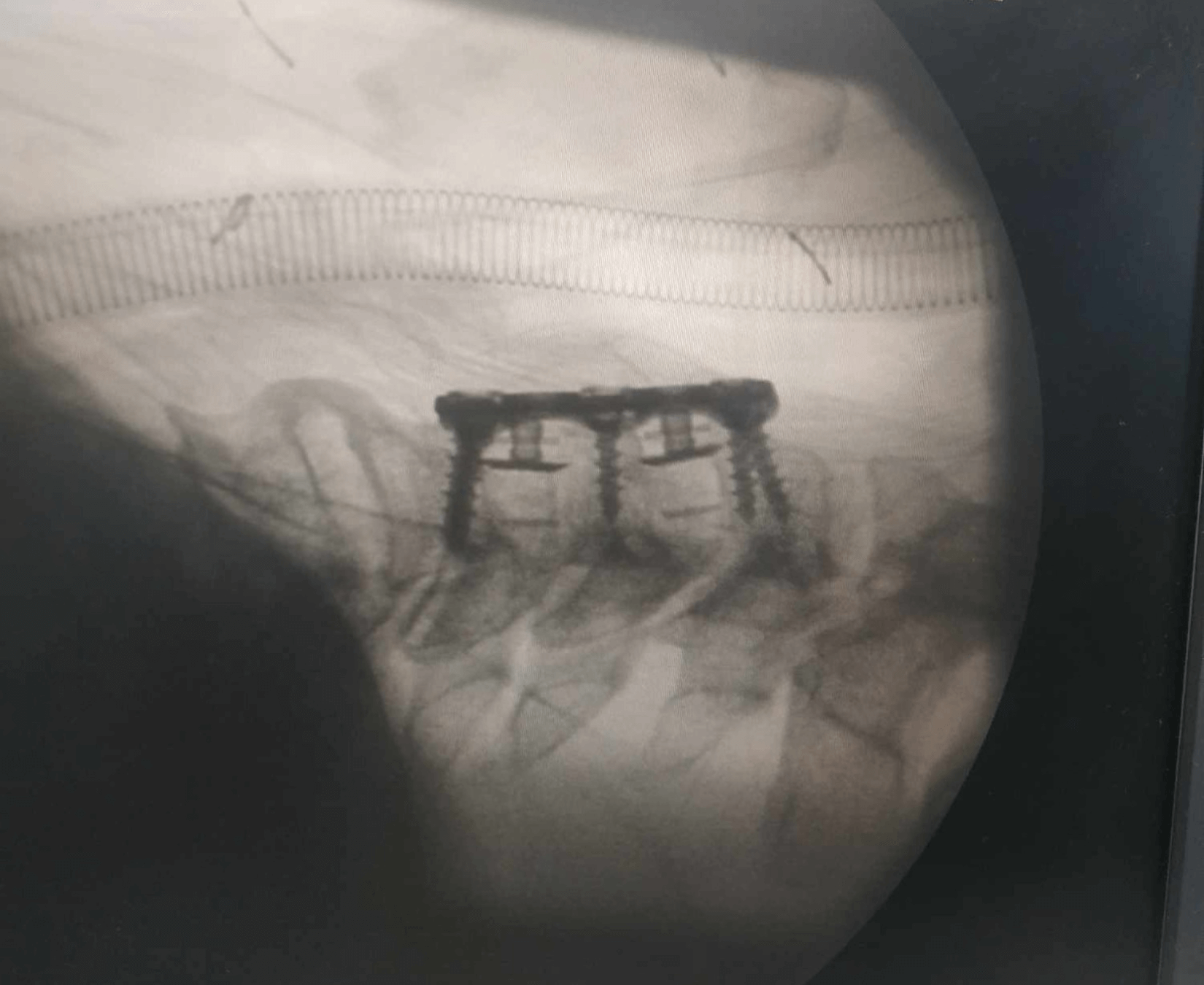 পদ্মা Cervical Plate - Image 8