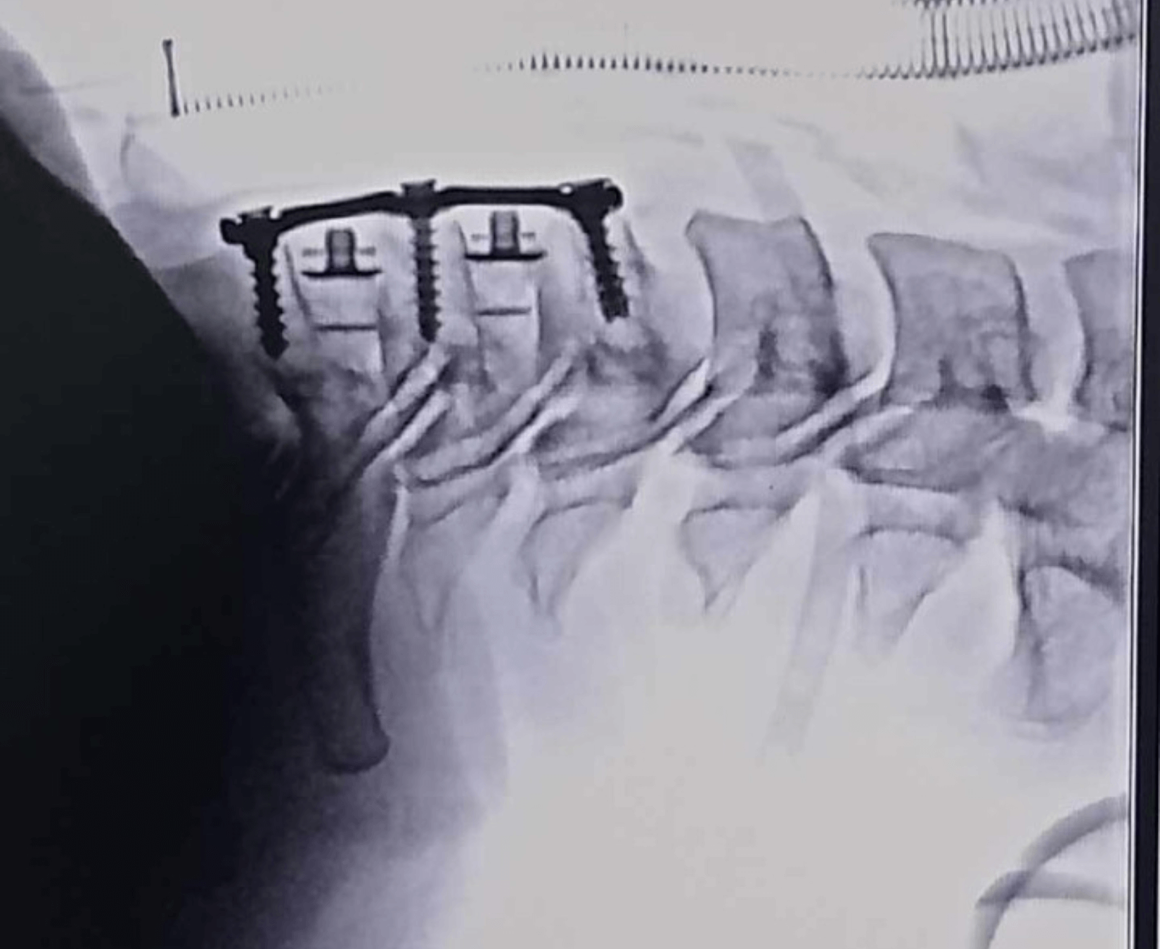 পদ্মা Cervical Plate - Image 6
