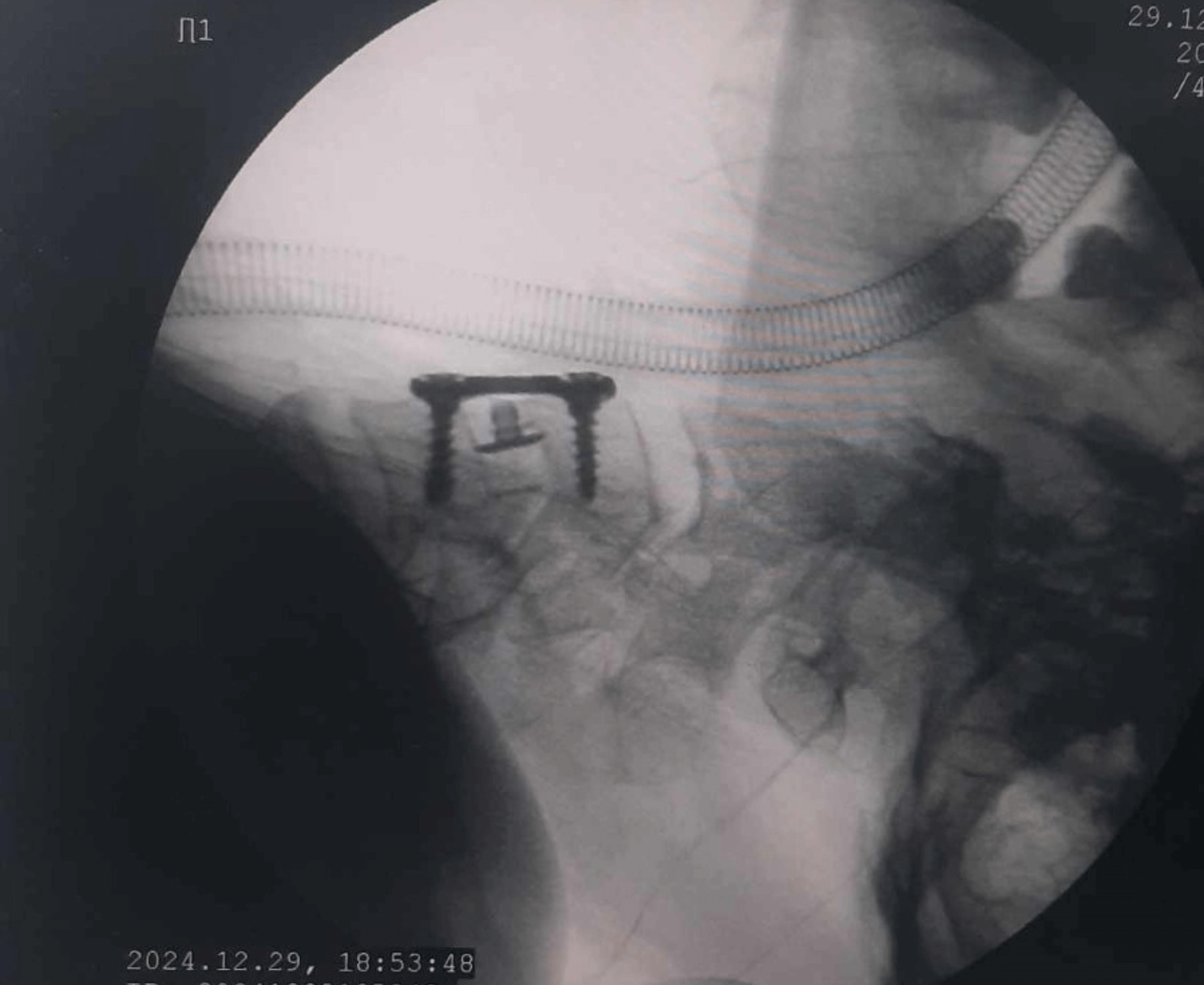 পদ্মা Cervical Plate - Image 7
